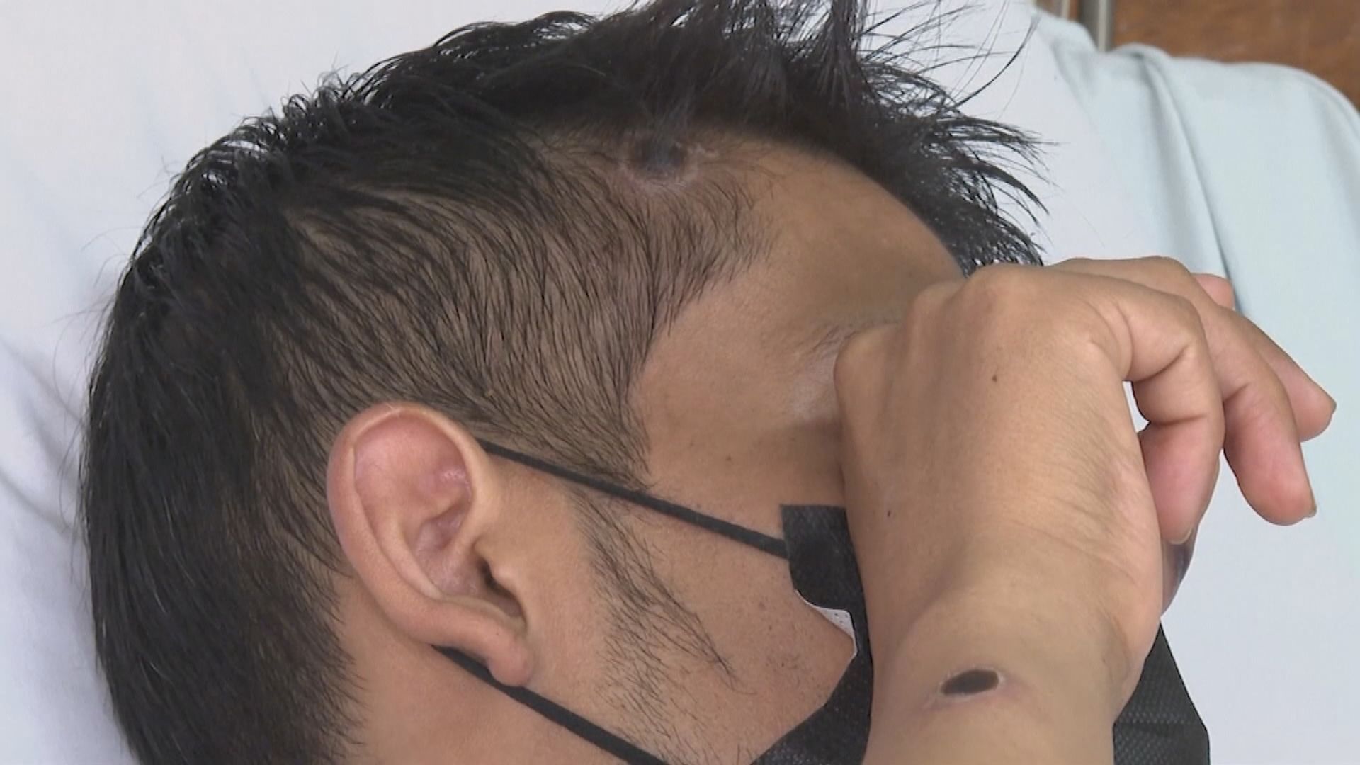 內地發現首宗猴痘輸入個案