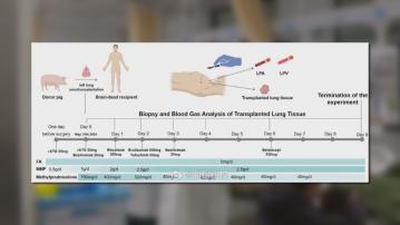 全球首例｜內地研究團隊成功將基因編輯豬肺移植人體　未來或有望紓緩肺移植器官短缺