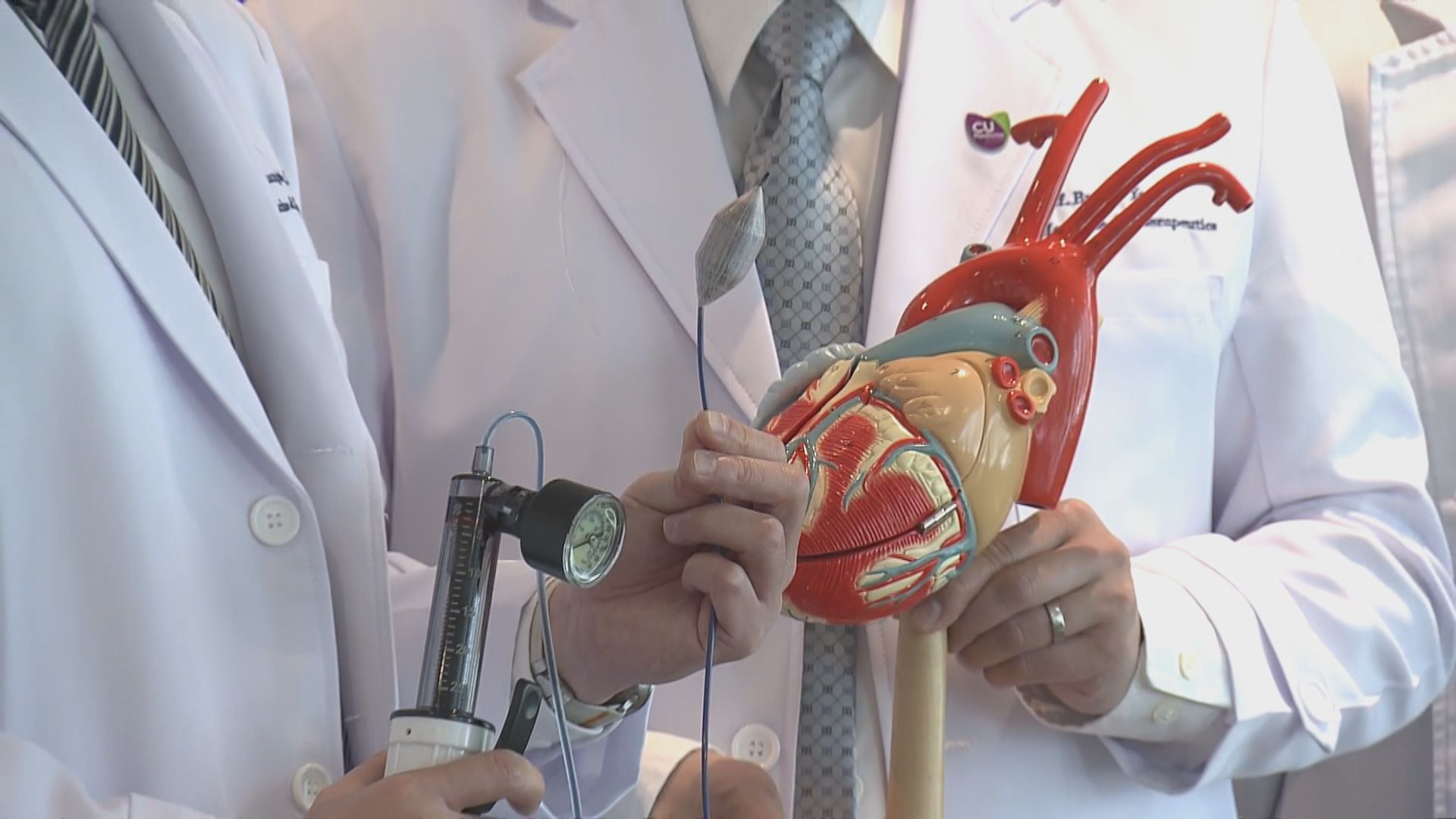 中大研球囊心包切開術　晚期癌病人心包積水復發率減8成