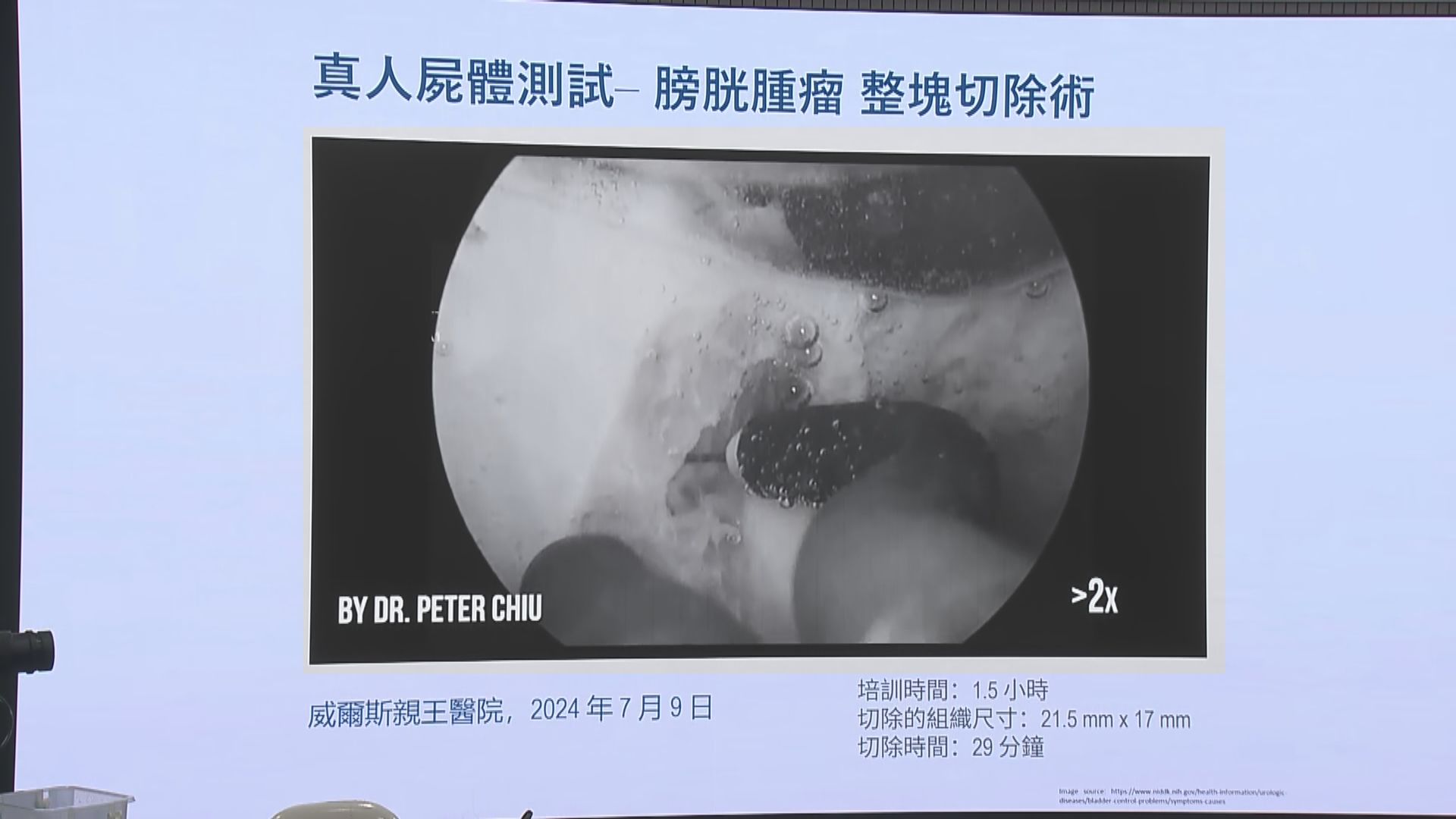 中大利用港產機械人　輔助切除膀胱腫瘤屬全球首例