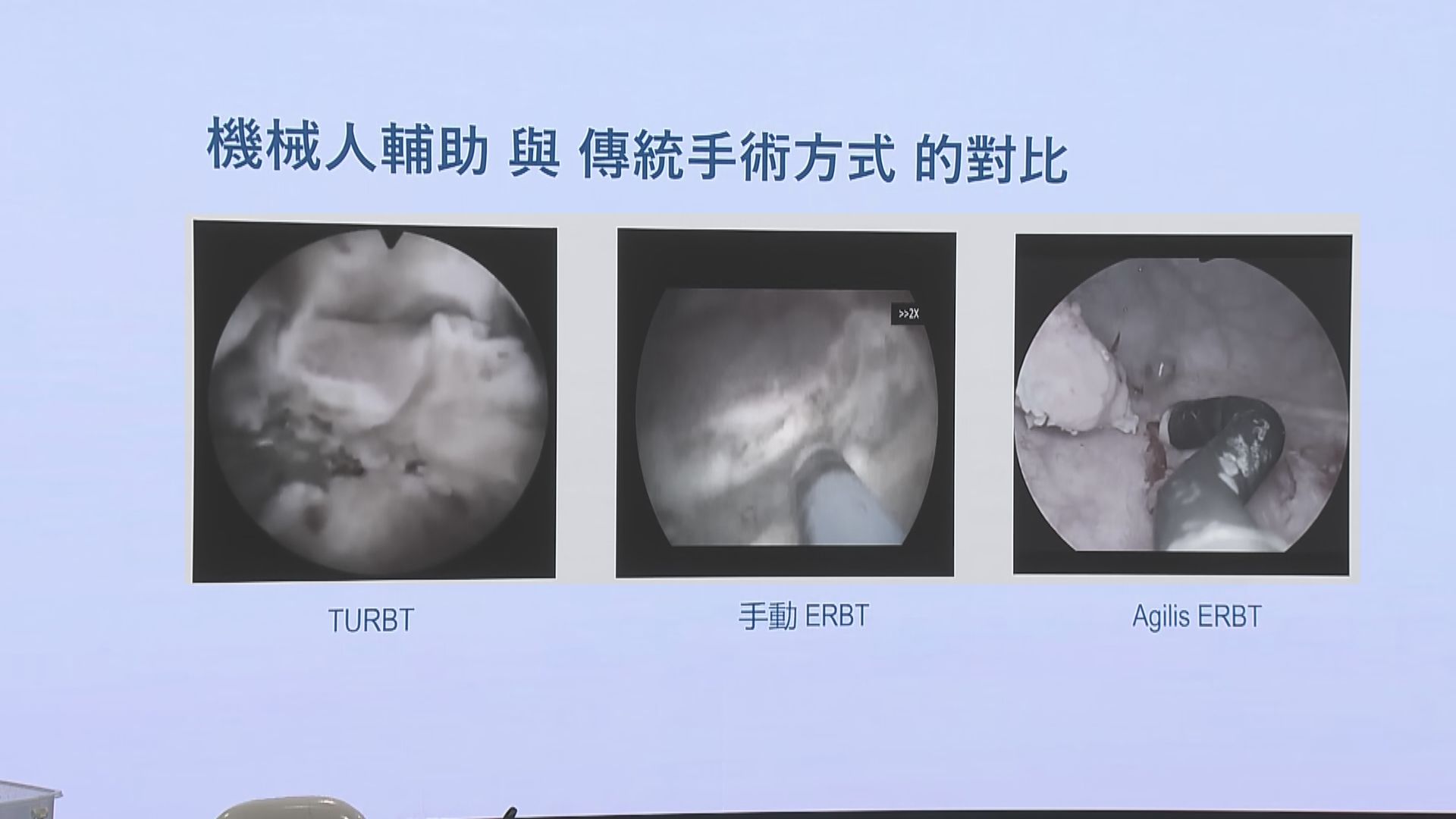 中大利用港產內鏡機械人切除膀胱腫瘤　提升安全度
