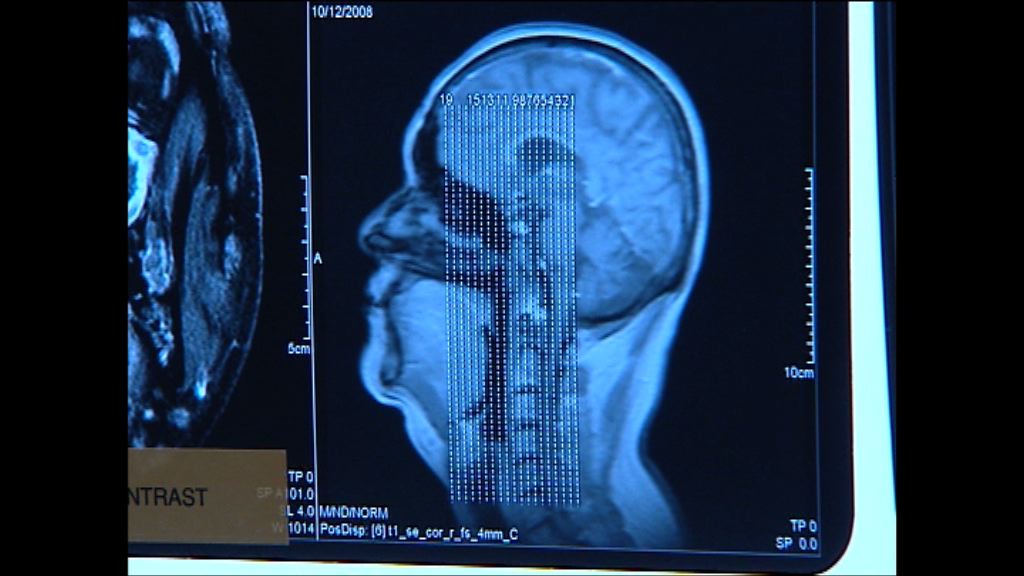 中大發現鼻咽癌新基因特質