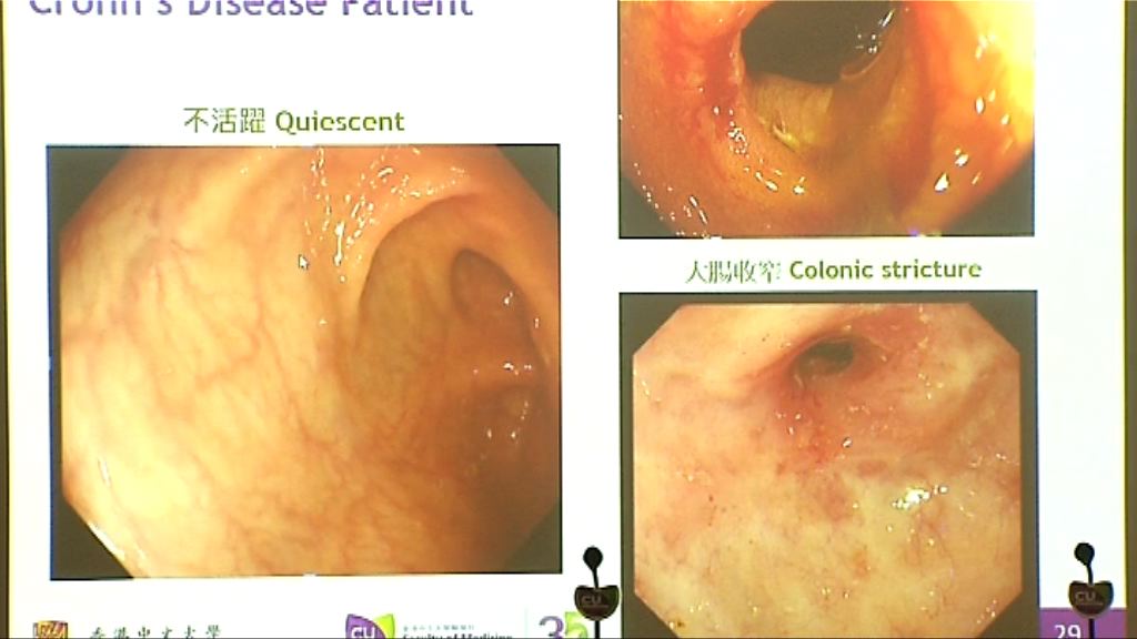 中大獲資助研究克隆氏症病理