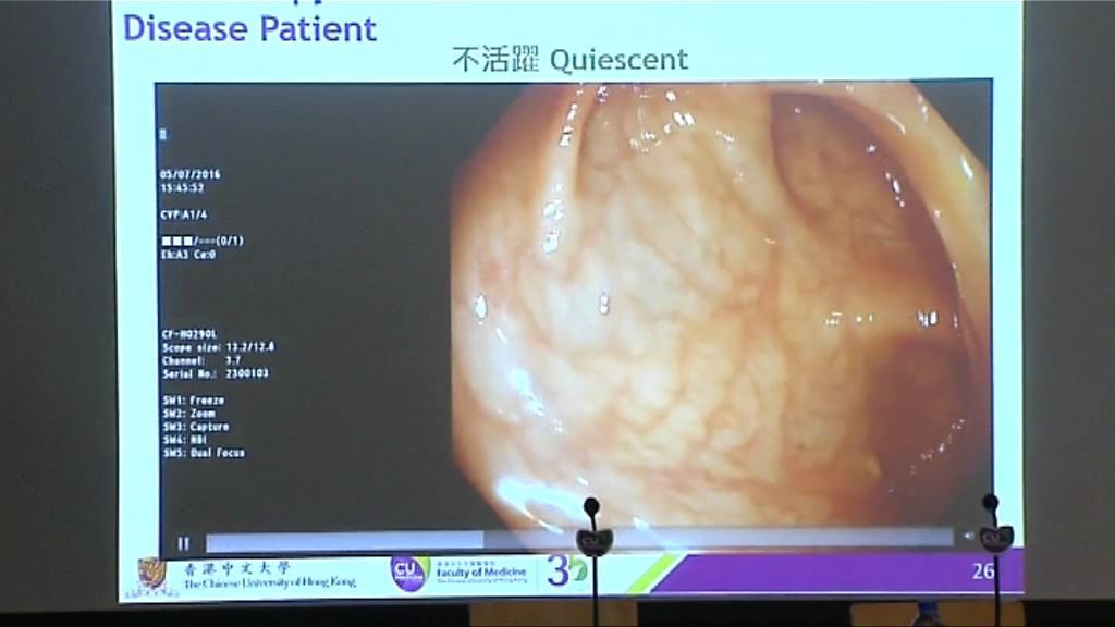 腸病克隆氏症發病率20年間升7倍
