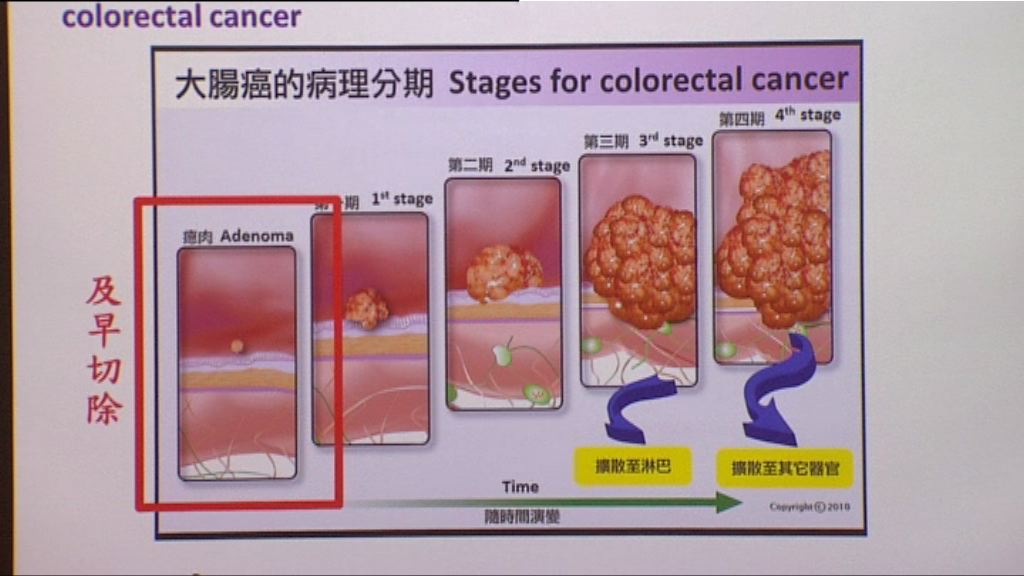 中大研究發現新大腸癌高風險群組