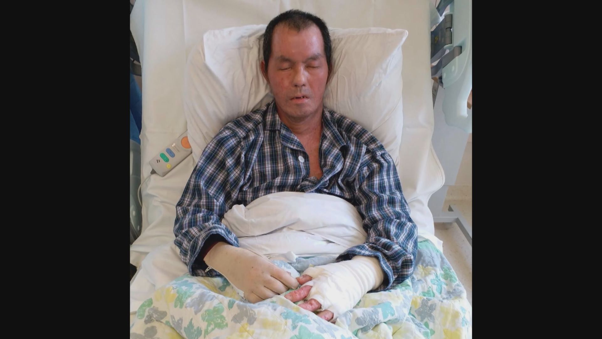 疑因政見被燒傷男子正排期做第四次植皮手術