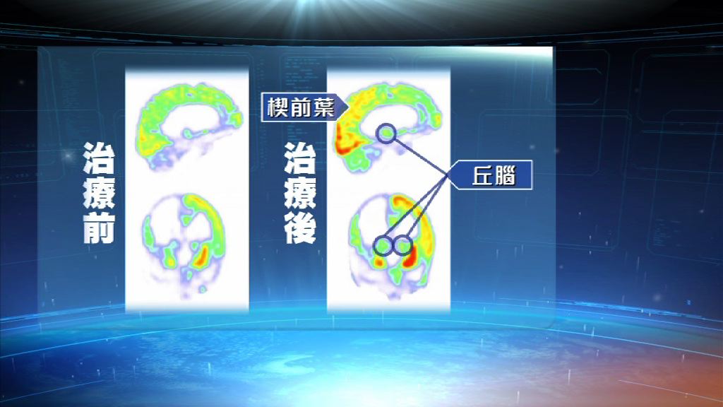 法國醫療團隊治療植物人取得突破