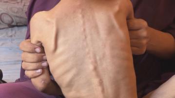 加沙過去三周近50人死於營養不良　聯合國：每五個兒童就有一個營養不良