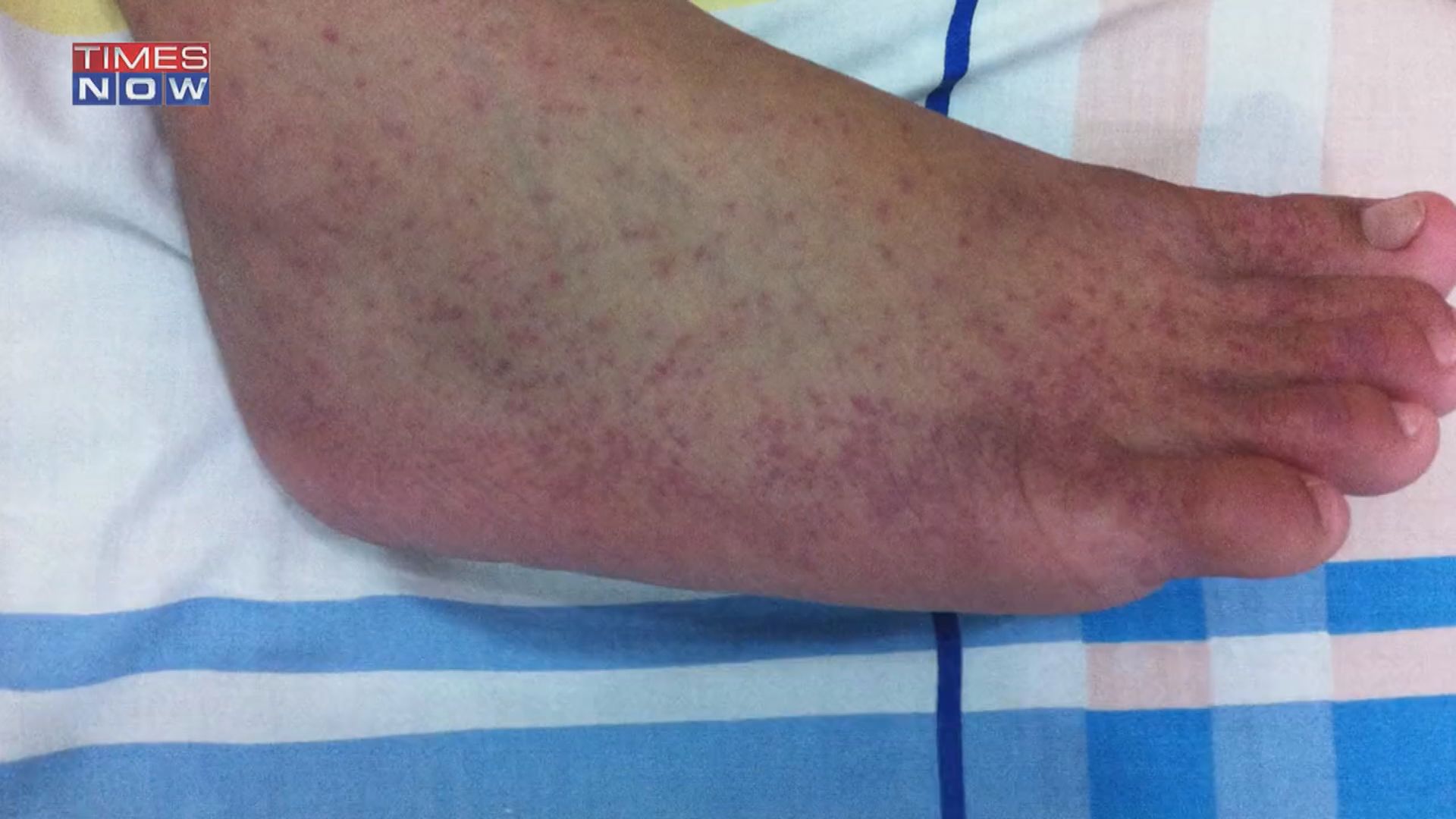 【環球薈報】專家警告「蕃茄流感」已成印度風土病　籲阻病毒擴散