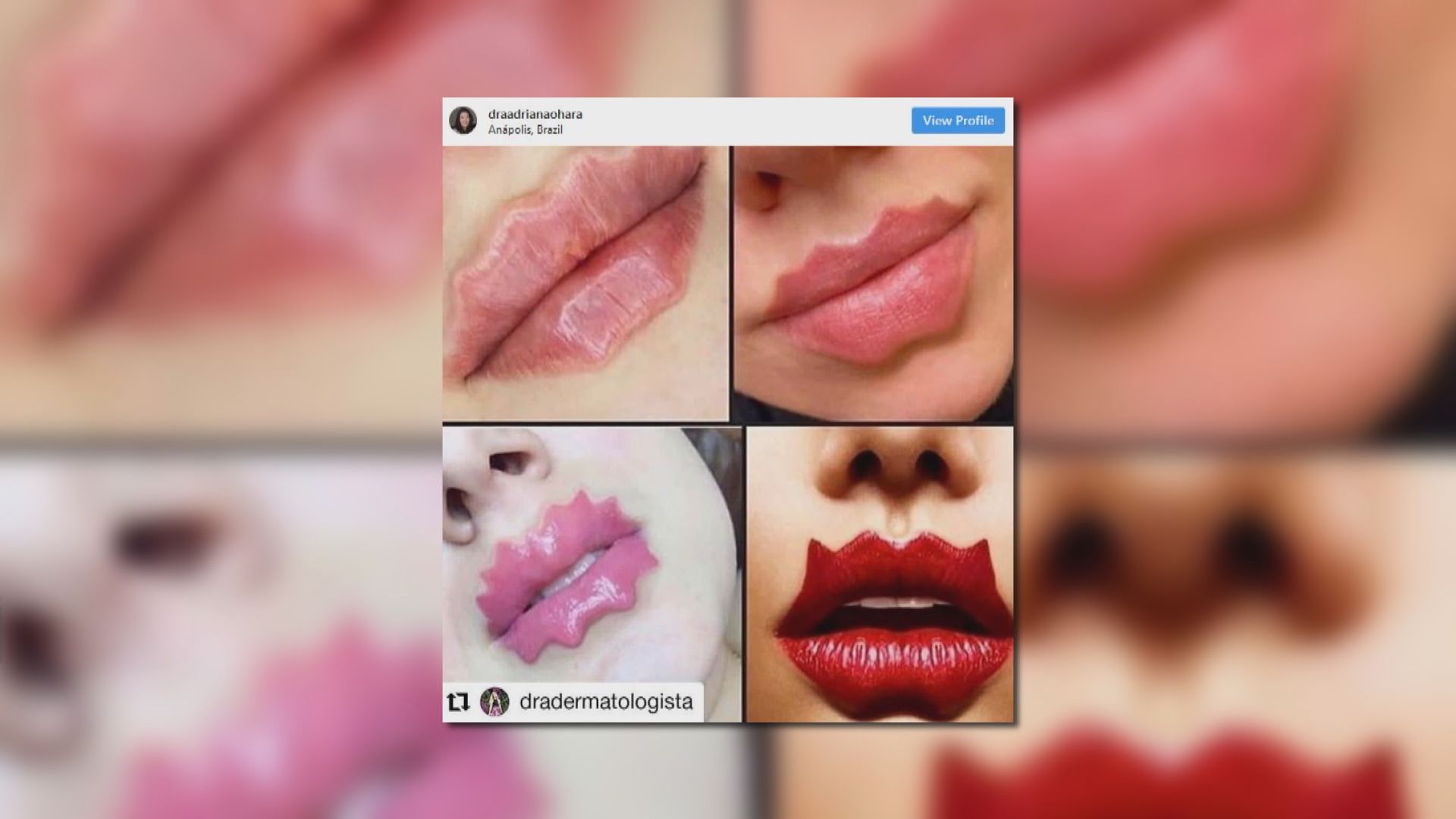 【環球薈報】俄國微整形「惡魔嘴唇」掀起熱潮