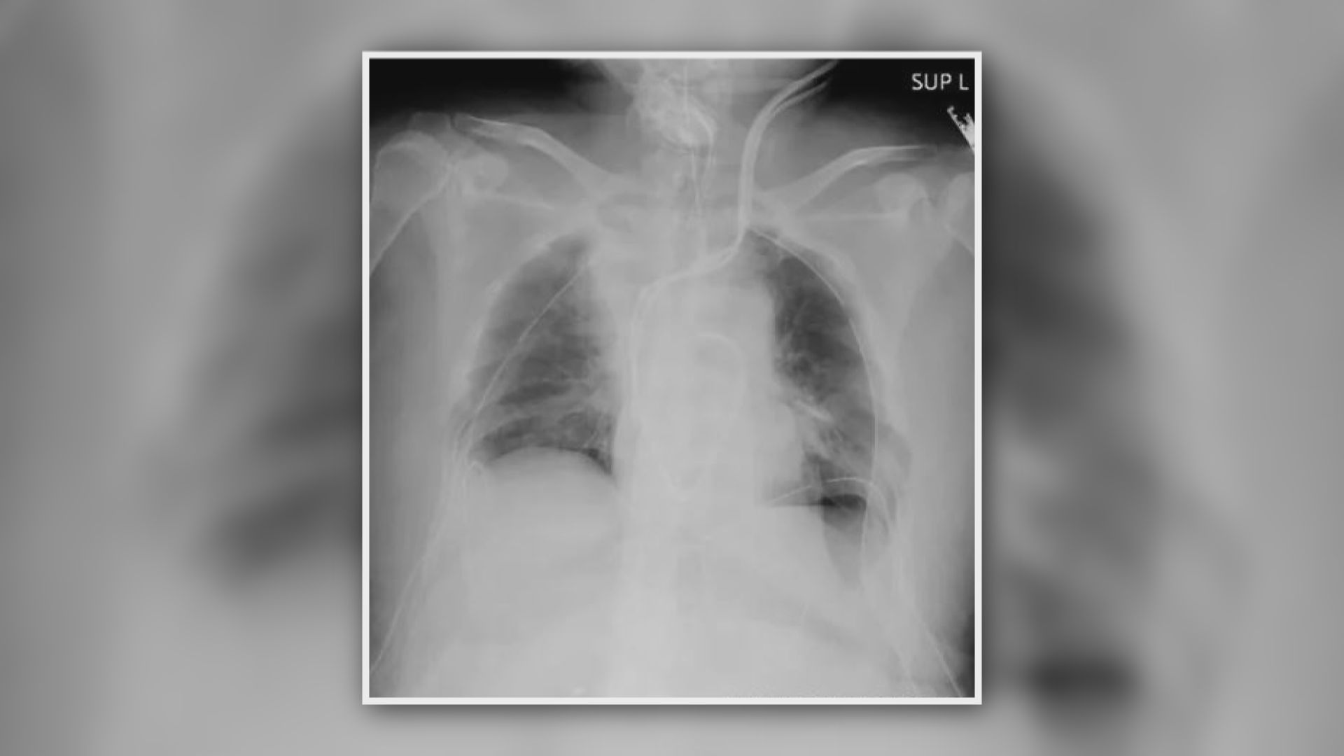 【環球薈報】京都大學全球首例新冠病毒肺部移植手術患者已出院