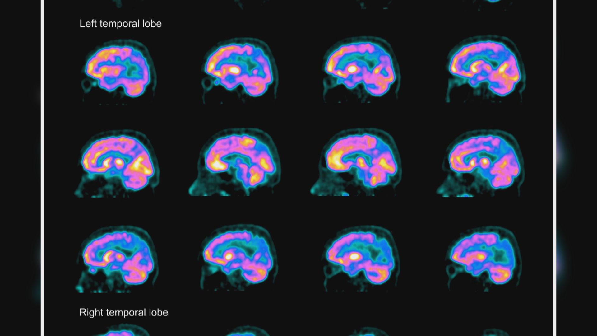 【環球薈報】研究發現新驗血方法能更準確測出認知障礙