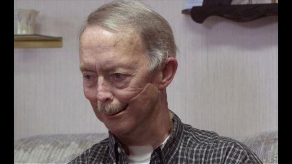 【環球薈報】3D打印技術助癌病人製新下巴