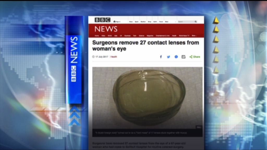 【環球薈報】英婦眼內藏27塊隱形眼鏡