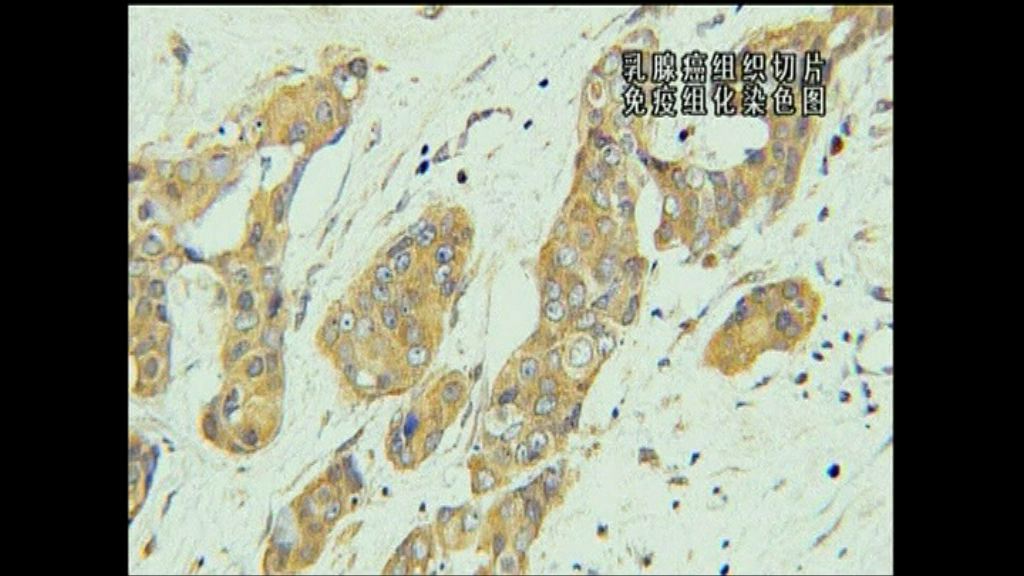 【環球薈報】壓力能令癌細胞六倍速度擴散