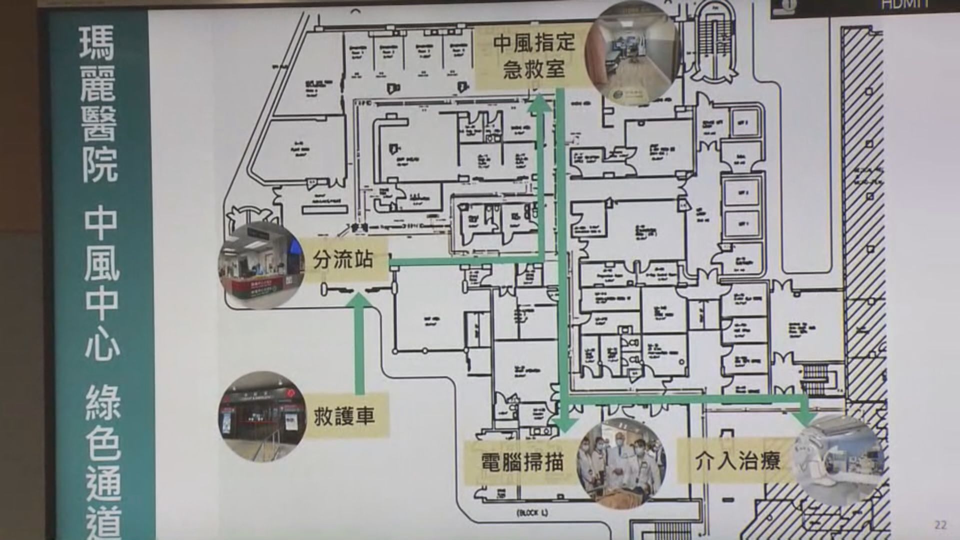 屯門醫院及瑪麗醫院成全港首批國家認證中風中心