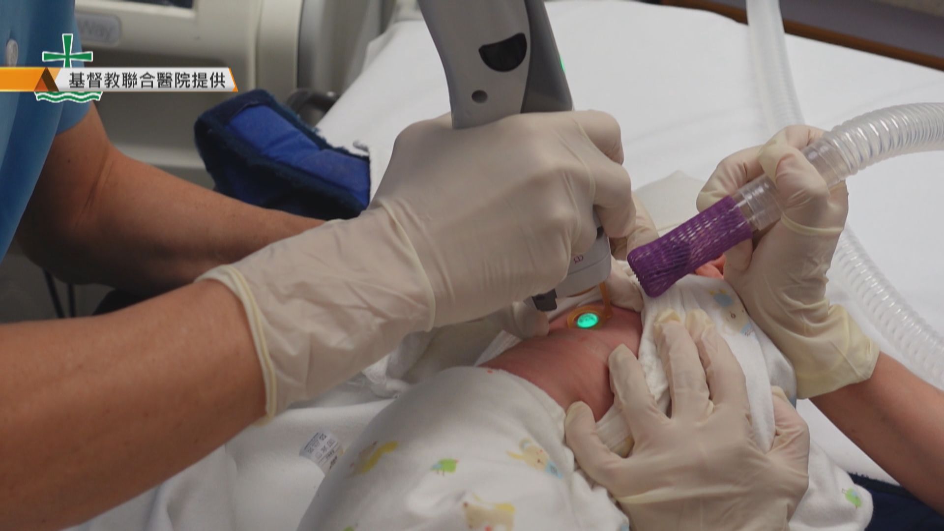 聯合醫院團隊以新激光技術治療酒紅斑痣　病童家長稱效果好