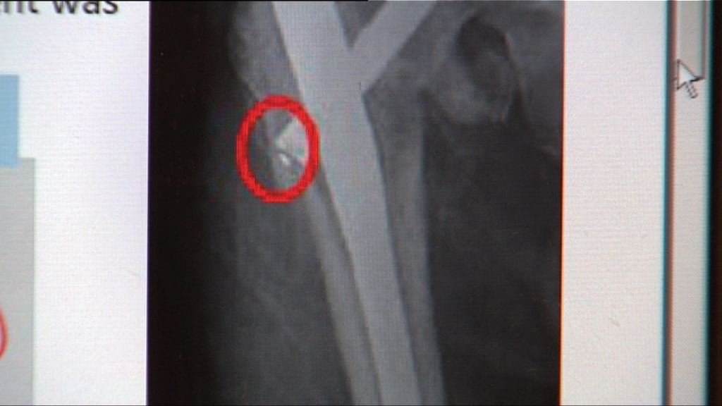 有病人手術後體內遺留儀器碎片