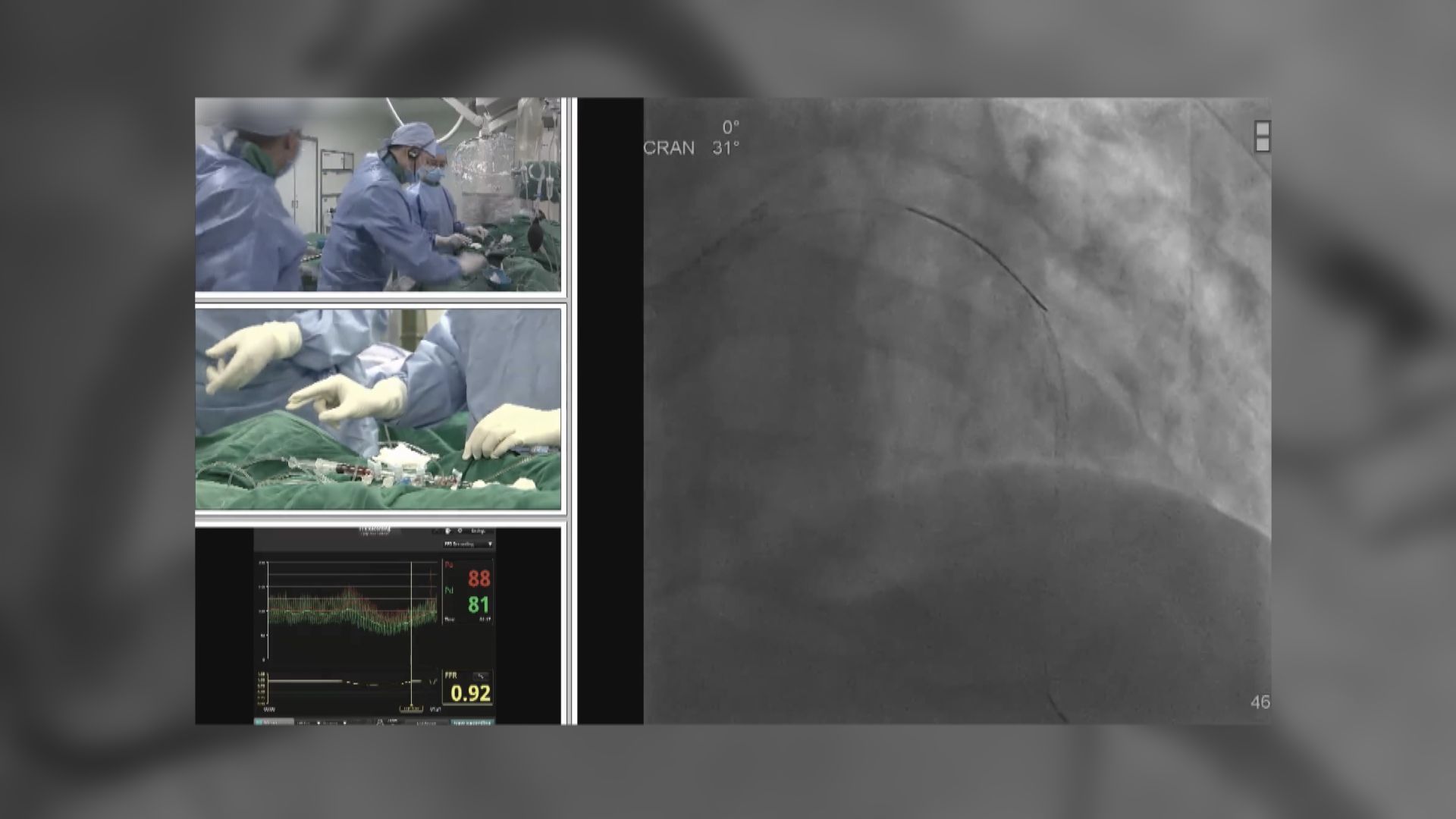 港大醫學院證電腦運算模型助評估「通波仔」需要 冀醫管局應用