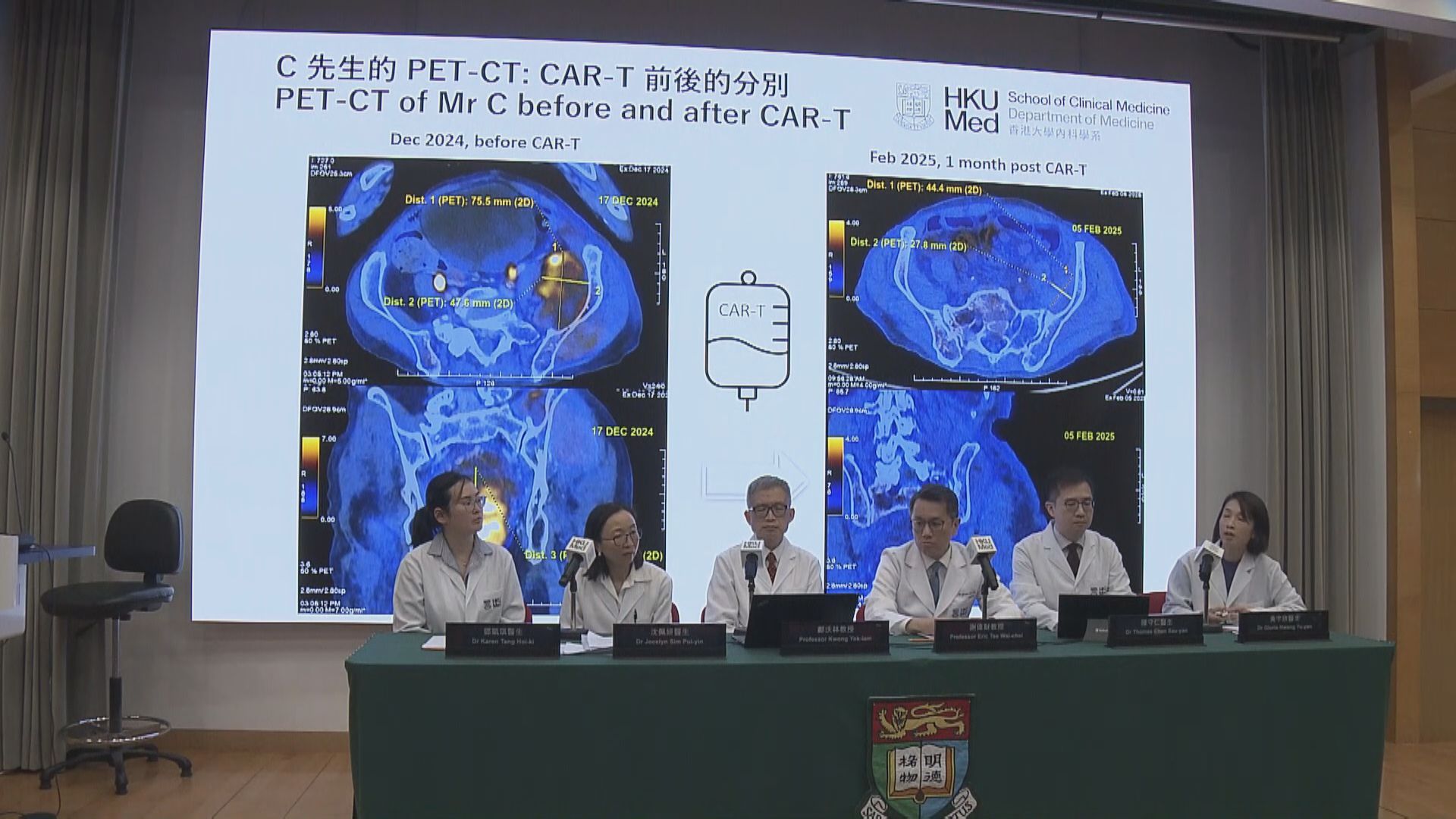 港大醫學院引入CAR-T細胞治療　成功治癒多發性骨髓瘤病人