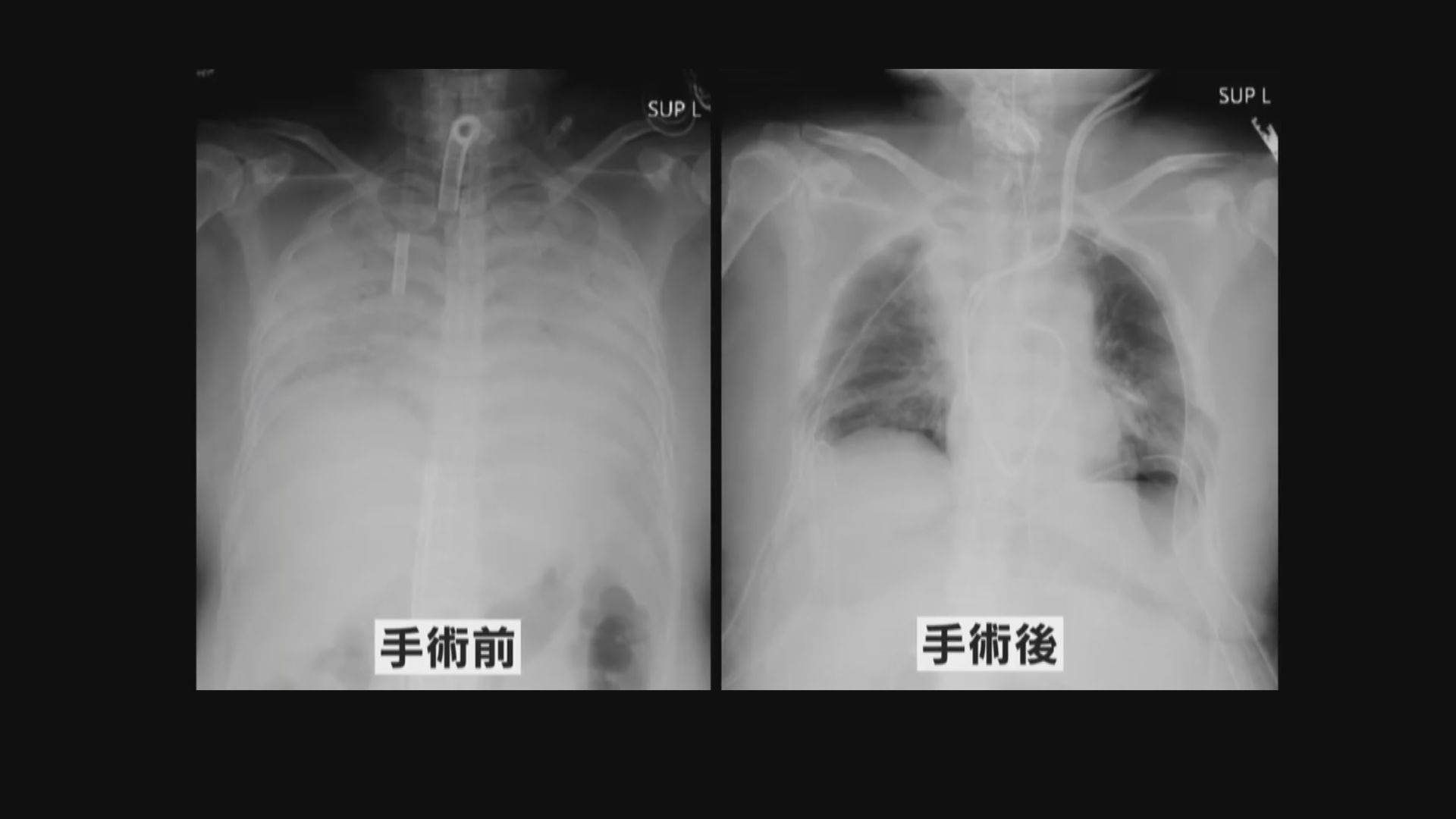 日本完成全球首個新冠病毒患者活體肺移植手術