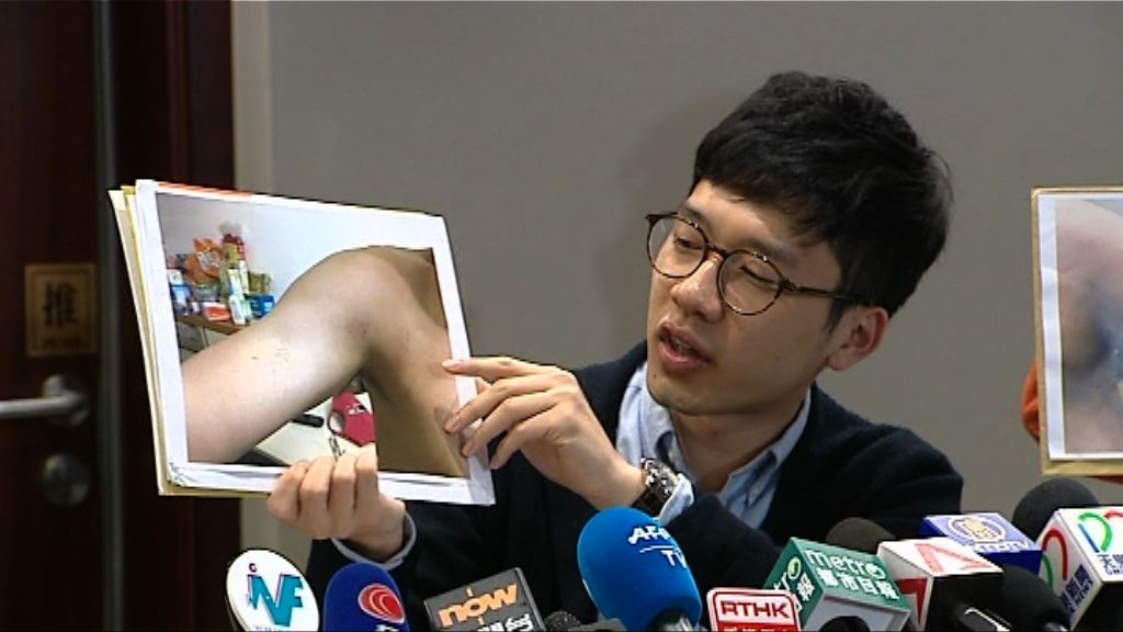 羅冠聰機場遇襲後展示傷勢