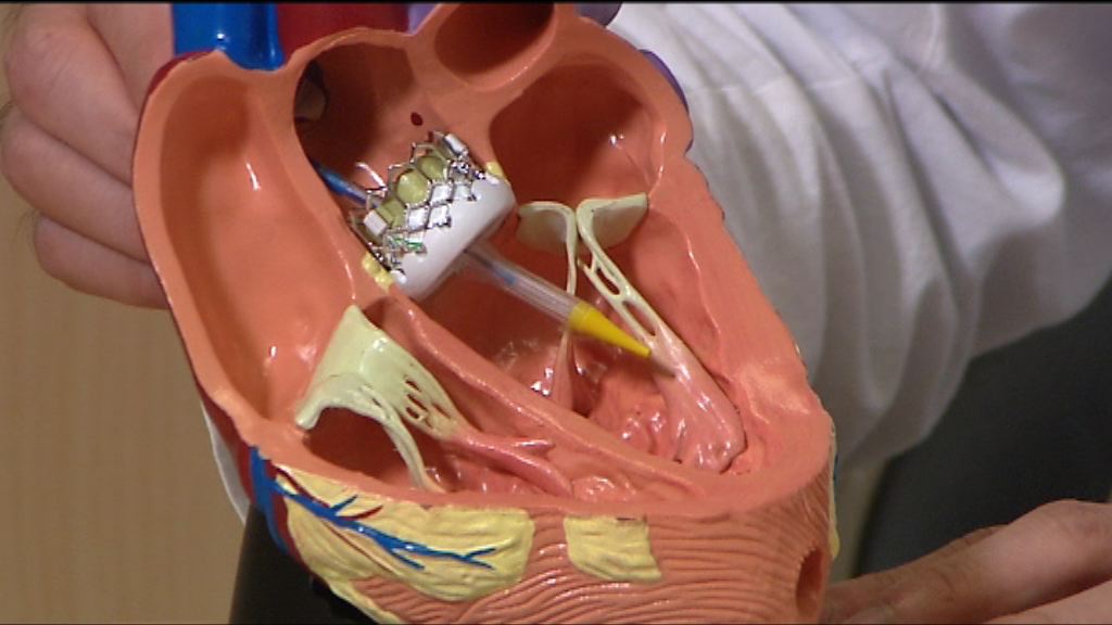 【杏林在線】心瓣置換新技術