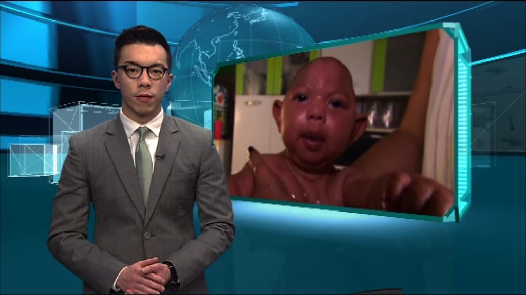 【新聞智庫】寨卡病毒與小頭症