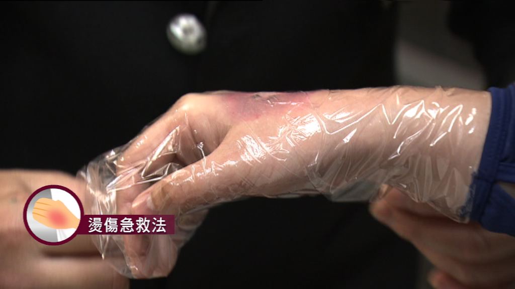 【杏林在線—健康1分鐘+】燙傷急救法