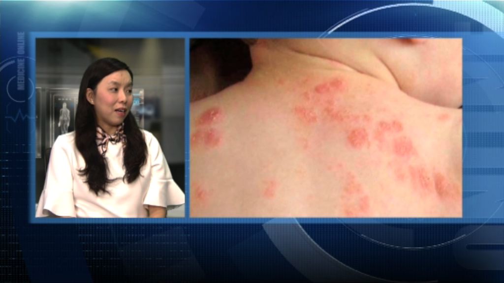 【杏林在線】濕疹兒童家庭支援