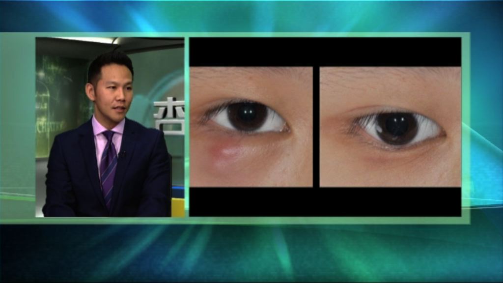 【杏林在線】避免及治療眼瘡