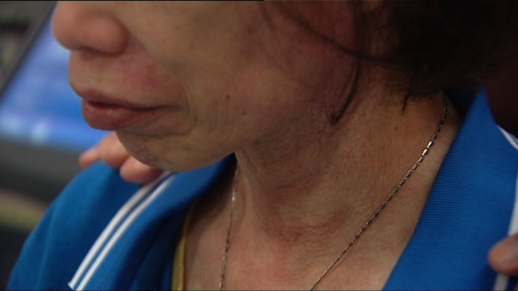 【杏林在線】正確認識皮肌炎