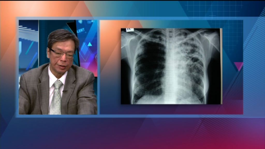 【杏林在線】肺結核病