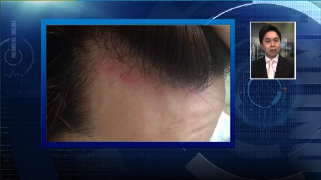 【杏林在線】頭皮敏感