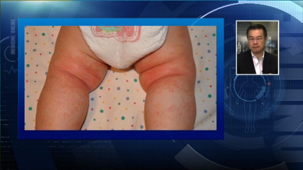 【杏林在線】母乳與防敏