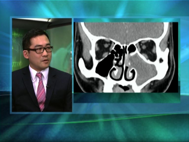 【杏林在線】鼻竇炎的治療與預防