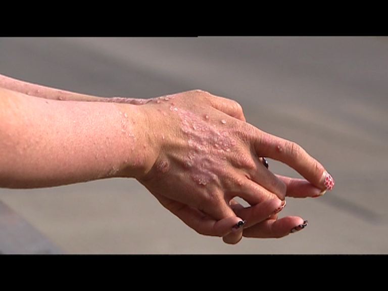 【杏林在線】銀屑病