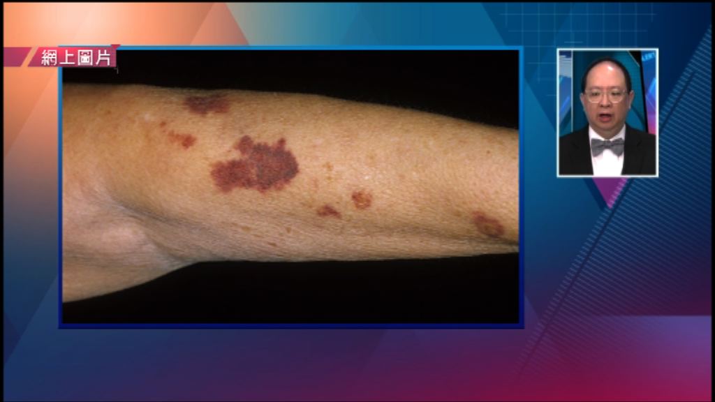 【杏林在線】解決「瘀」事 