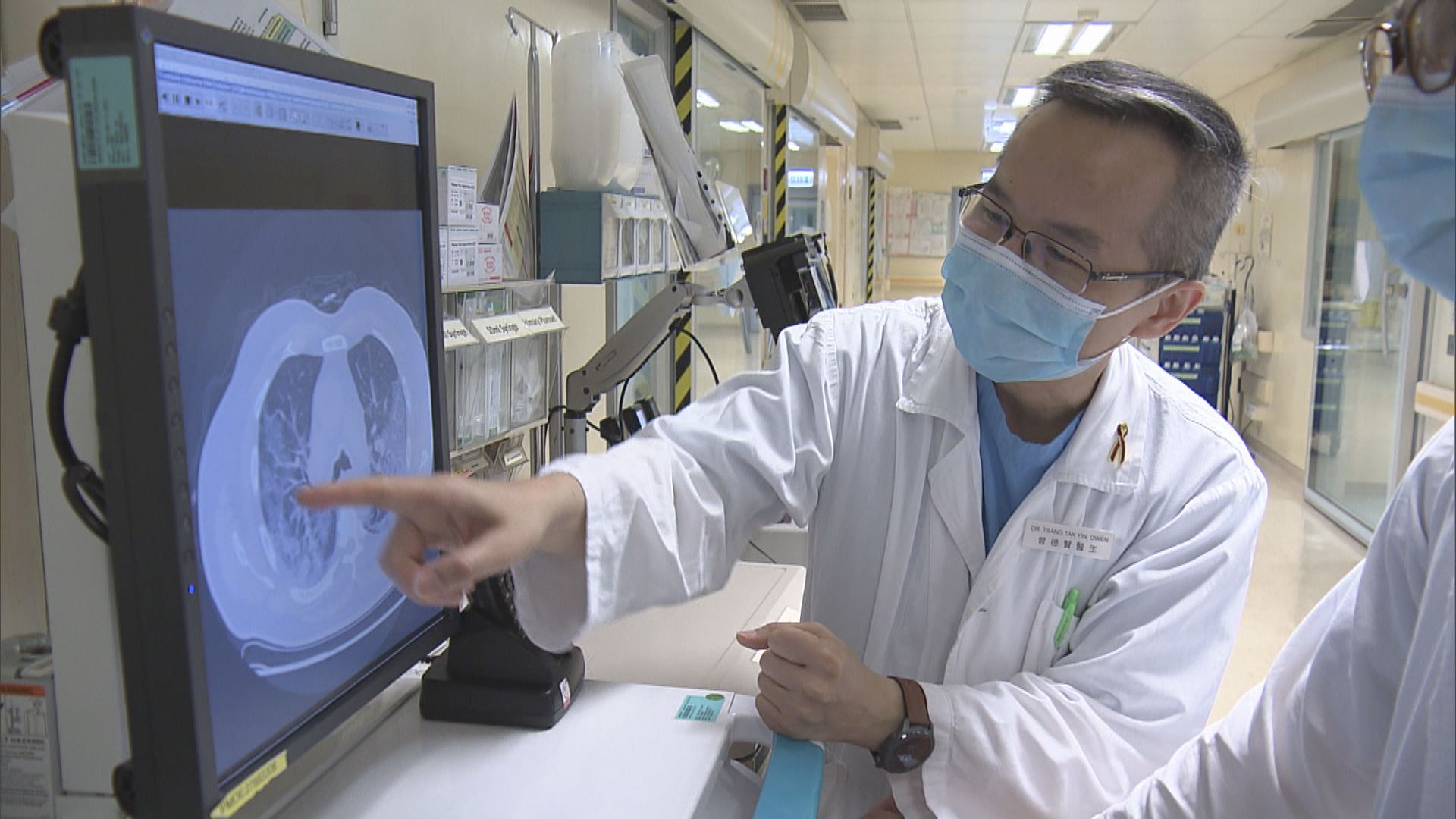 一半新冠病毒康復者換氣量不達標　部分病人現抑鬱徵狀