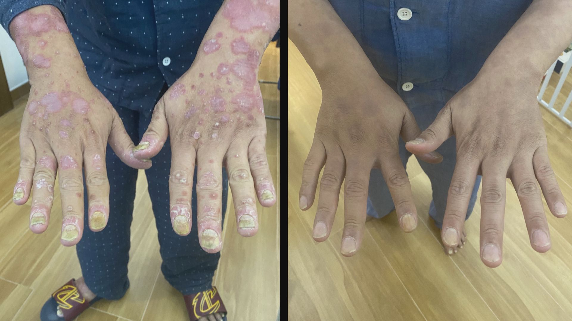 施政報告周三發表 銀屑病友會倡降生物製劑公營治療門檻