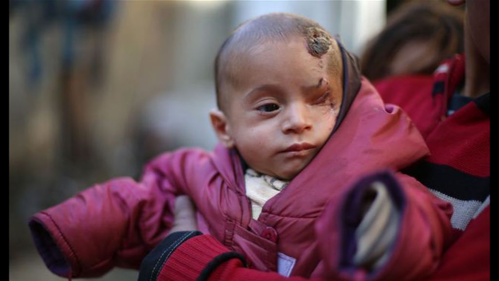 敘利亞男嬰獨眼照引起國際迴響