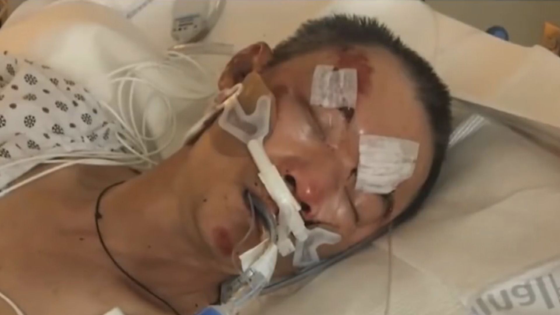 61歲華裔男子紐約街頭遇襲後重傷昏迷　情況危殆