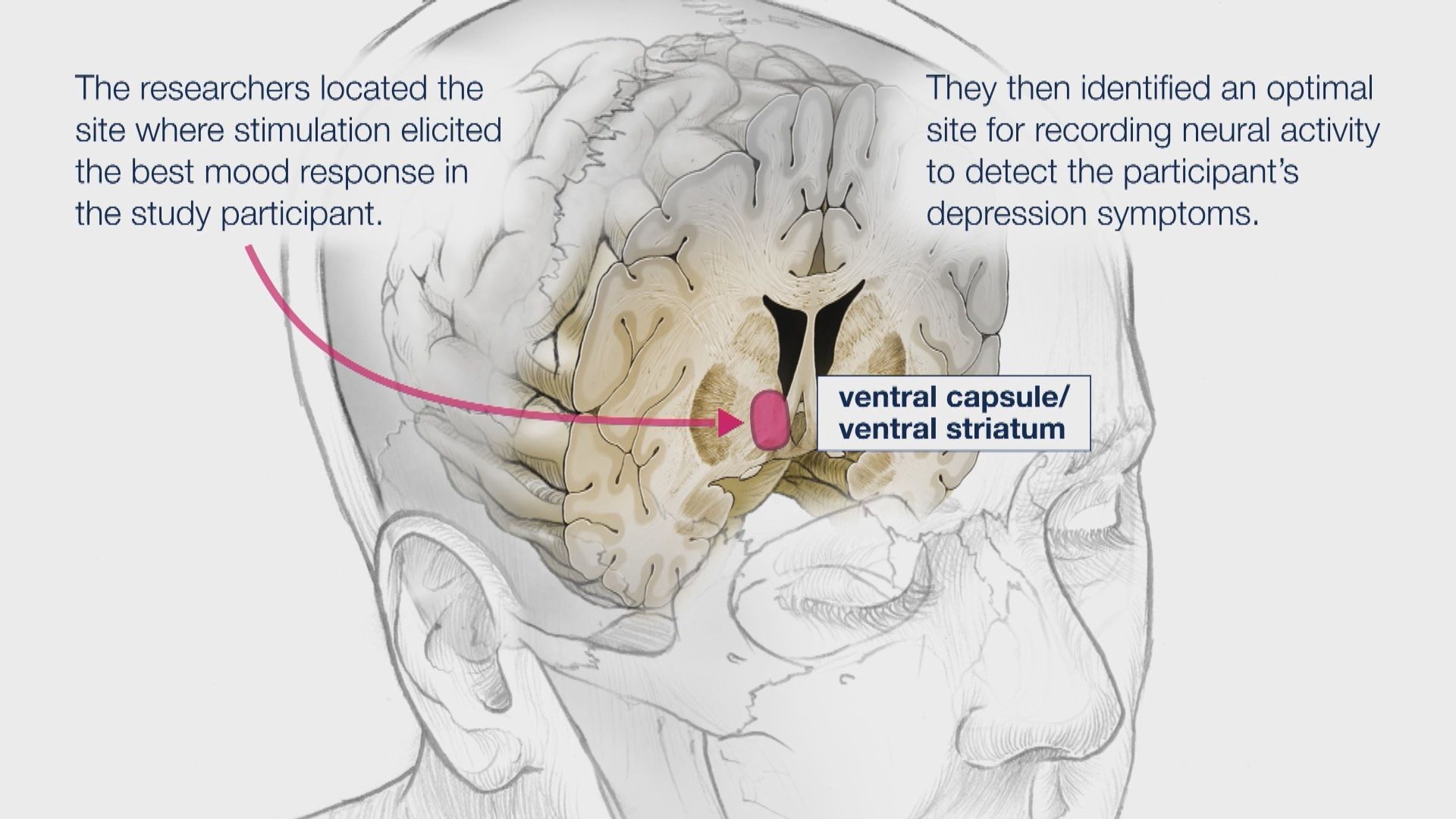 植入大腦刺激裝置助治療嚴重抑鬱症