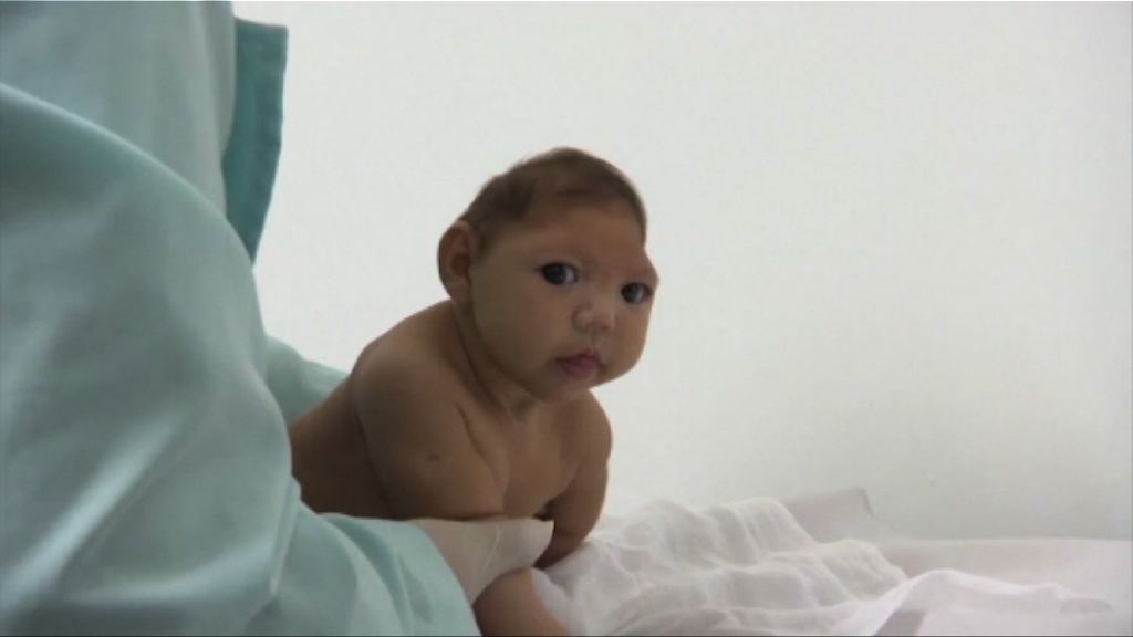 美國確認寨卡病毒導致小頭症