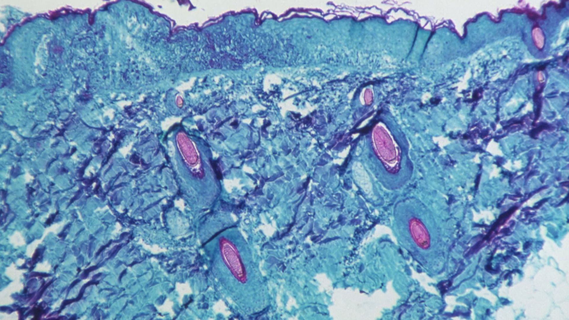 全球約二十個國家報告發現猴痘患者