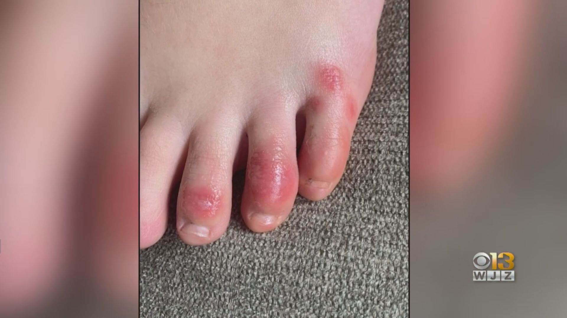 醫學界發現確診者由頭到腳趾都可以出現病徵