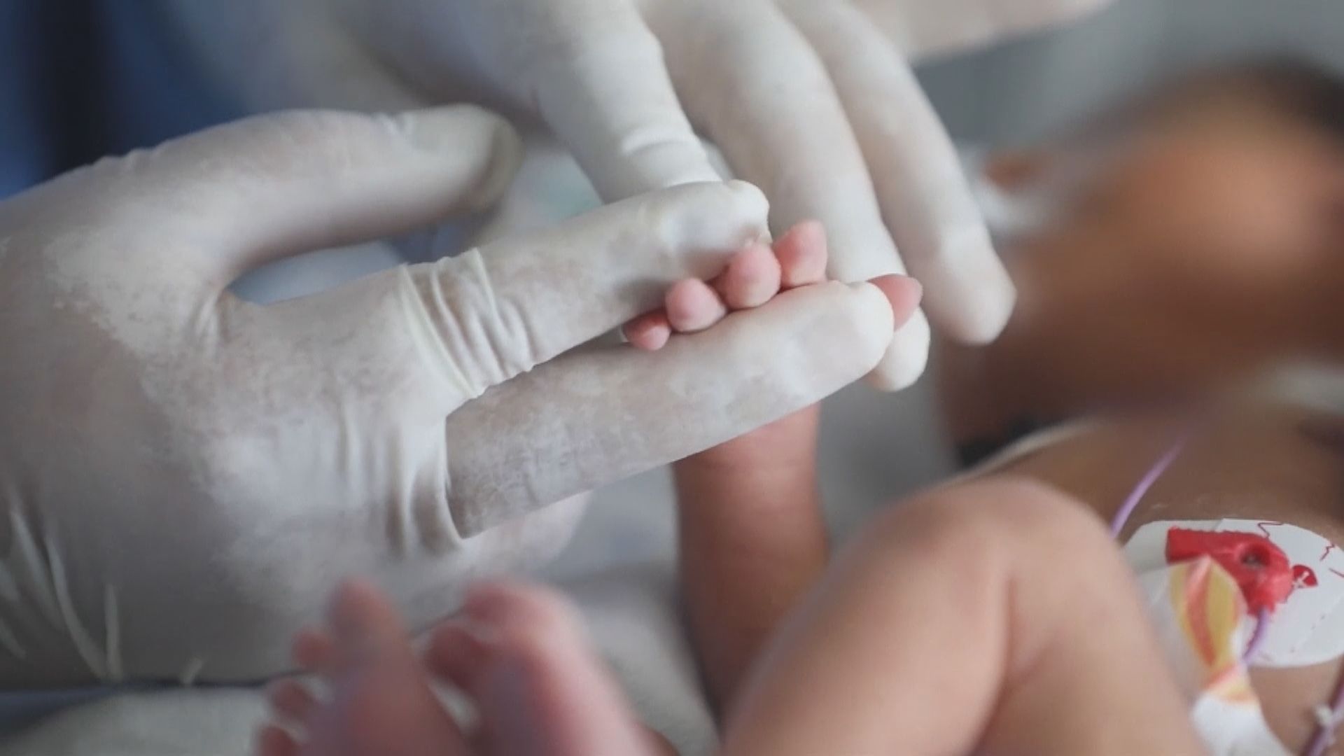 多地兒童出現罕見及嚴重發炎　臨床徵狀與川崎症相似